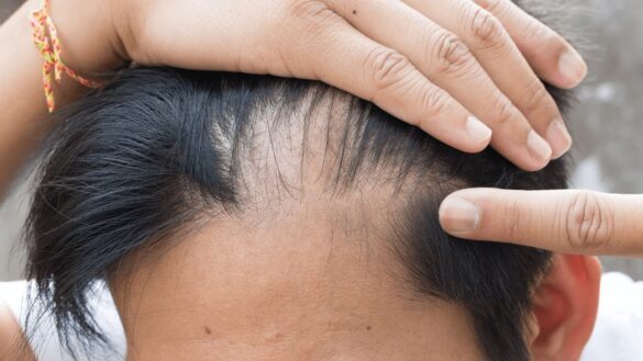 Receding Hairline Meaning Types Causes Regrowth Treatments And