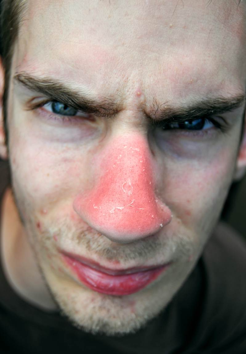 Sunburn on nose