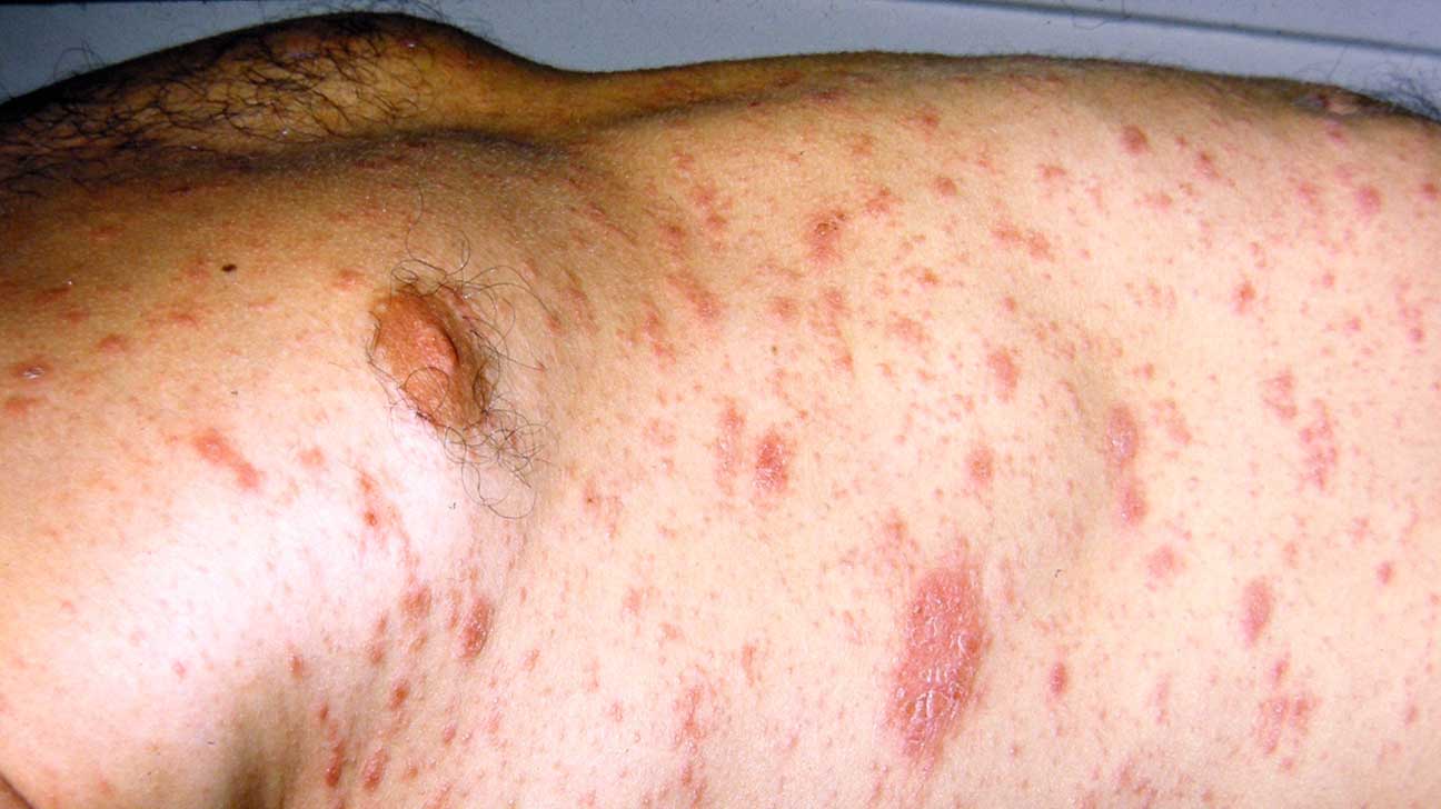Stomach Rash Causes, Itchy, on Navel, Back, Breast or
