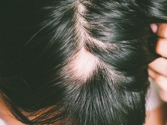 Do Sore Scalp Cause Hair Loss 585x439 
