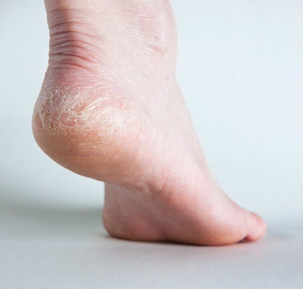 What Causes Sore Spots On Bottom Of Feet