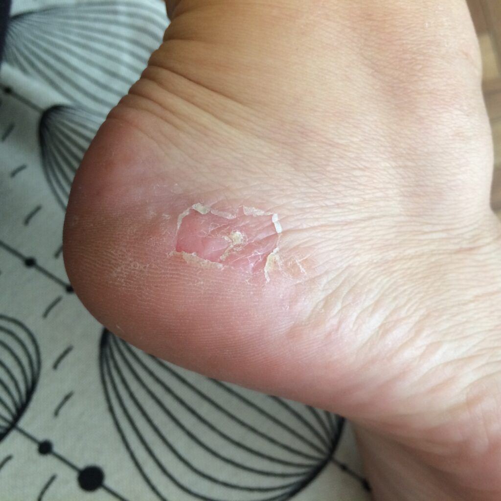 Dry Skin On Bottom Of Feet