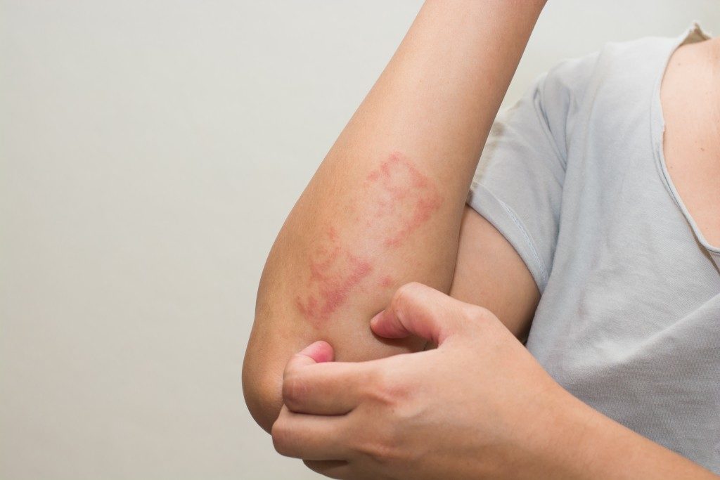 Rash On Arm Causes Itchy Red Treatments And Remedies American Celiac