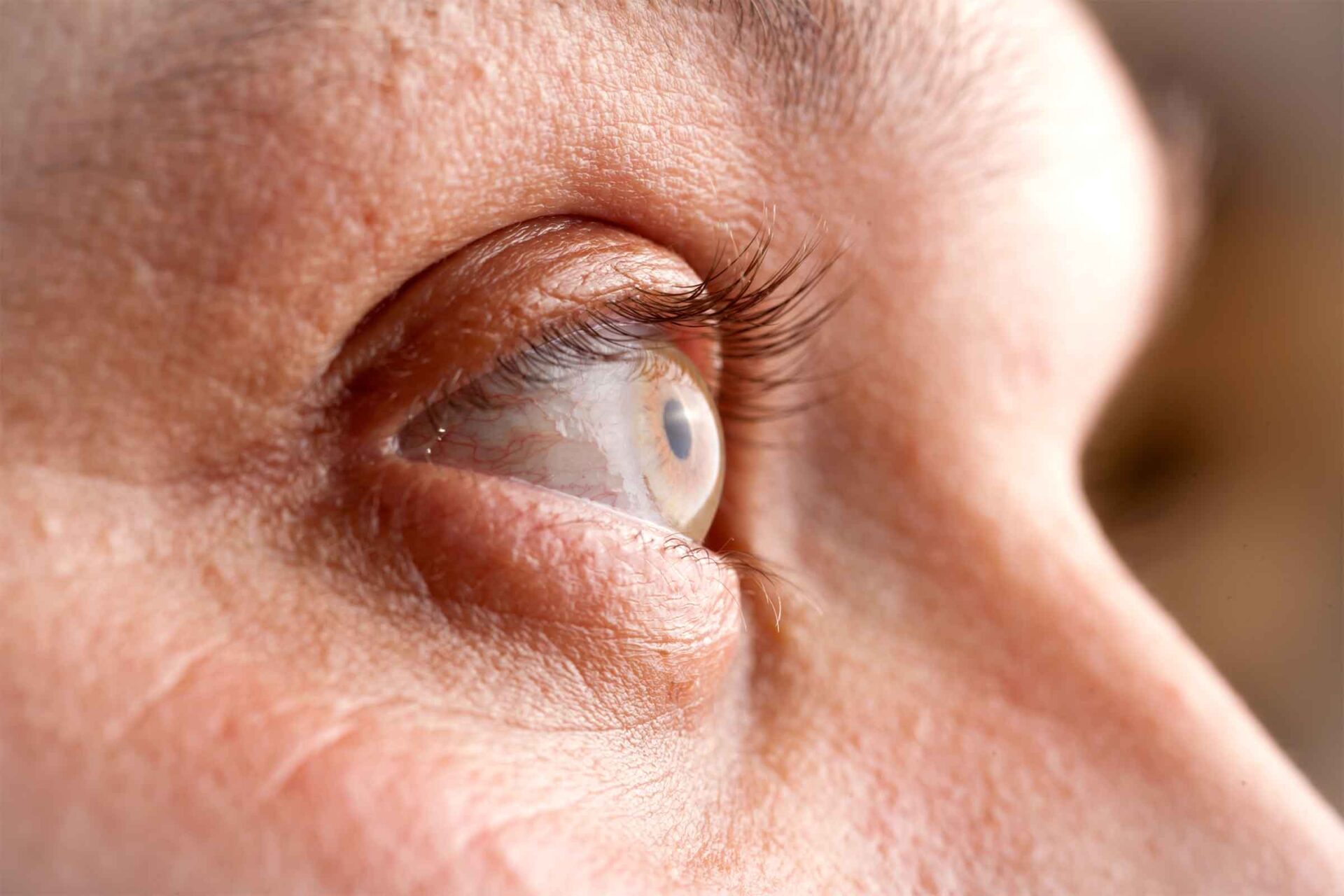 Red Ring Around Iris, Eyelids, Eye Socket, In Babies & More American