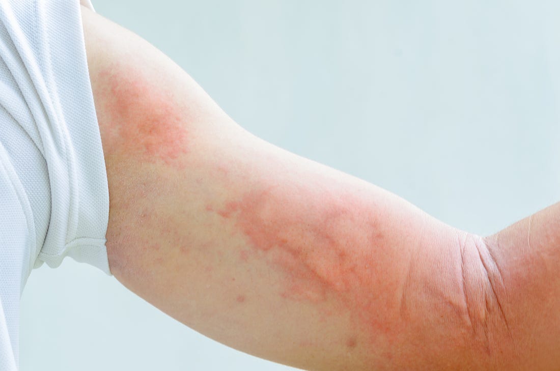 Rash On Arm Causes Itchy Red Treatments And Remedies American Celiac