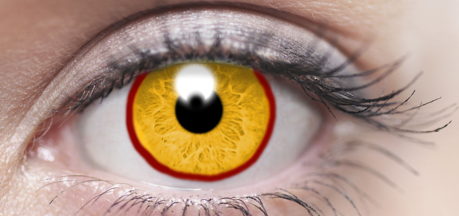 yellow ring around iris of eye