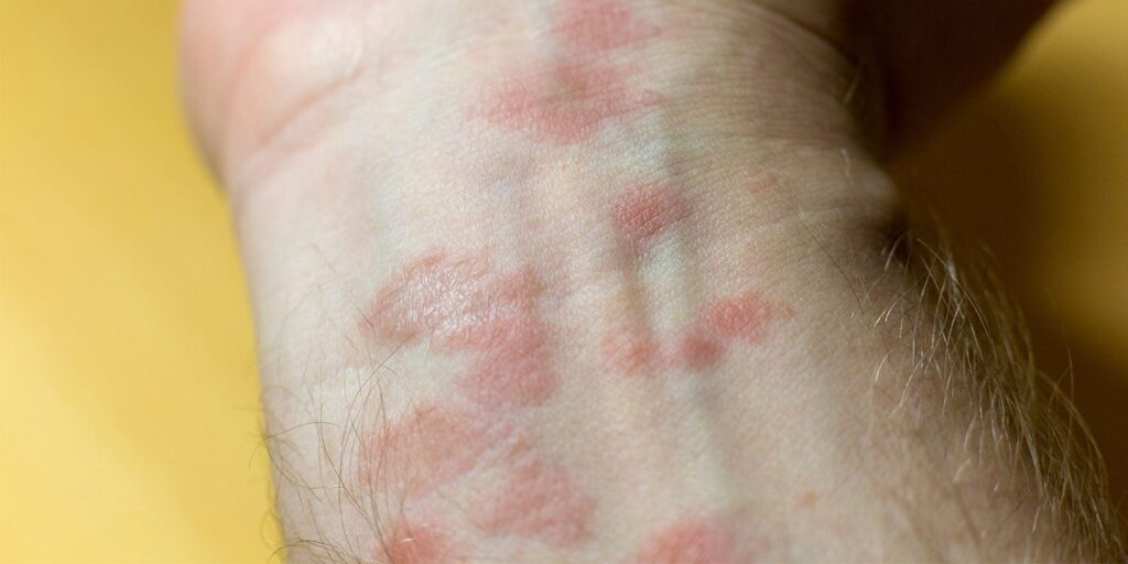 Rash On Arm Causes Itchy Red Treatments And Remedies American Celiac