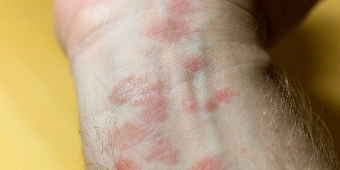 skin rashes that itch burn and spread