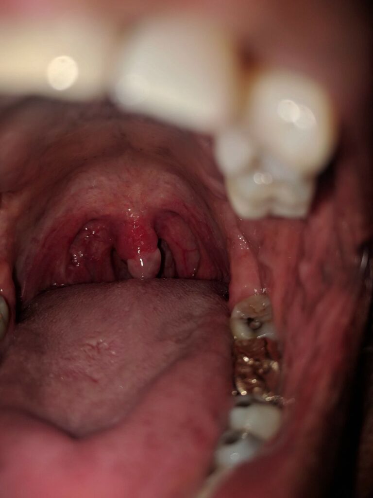 Swollen Uvula Cause: STDs, Snoring, After Drinking/Surgery - American