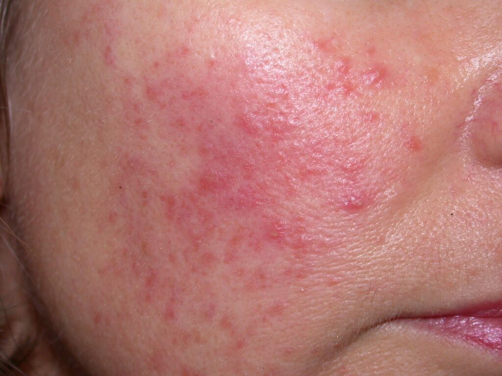 Itch or NonItchy Red Face Rash Causes and Treatments American Celiac