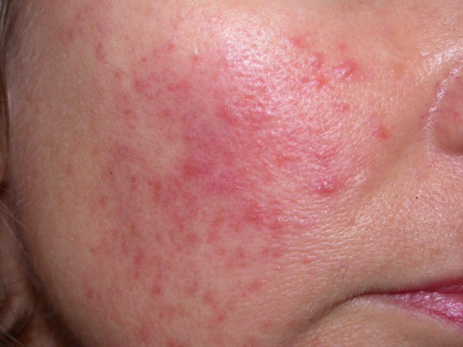 itch-or-non-itchy-red-face-rash-causes-and-treatments-american-celiac