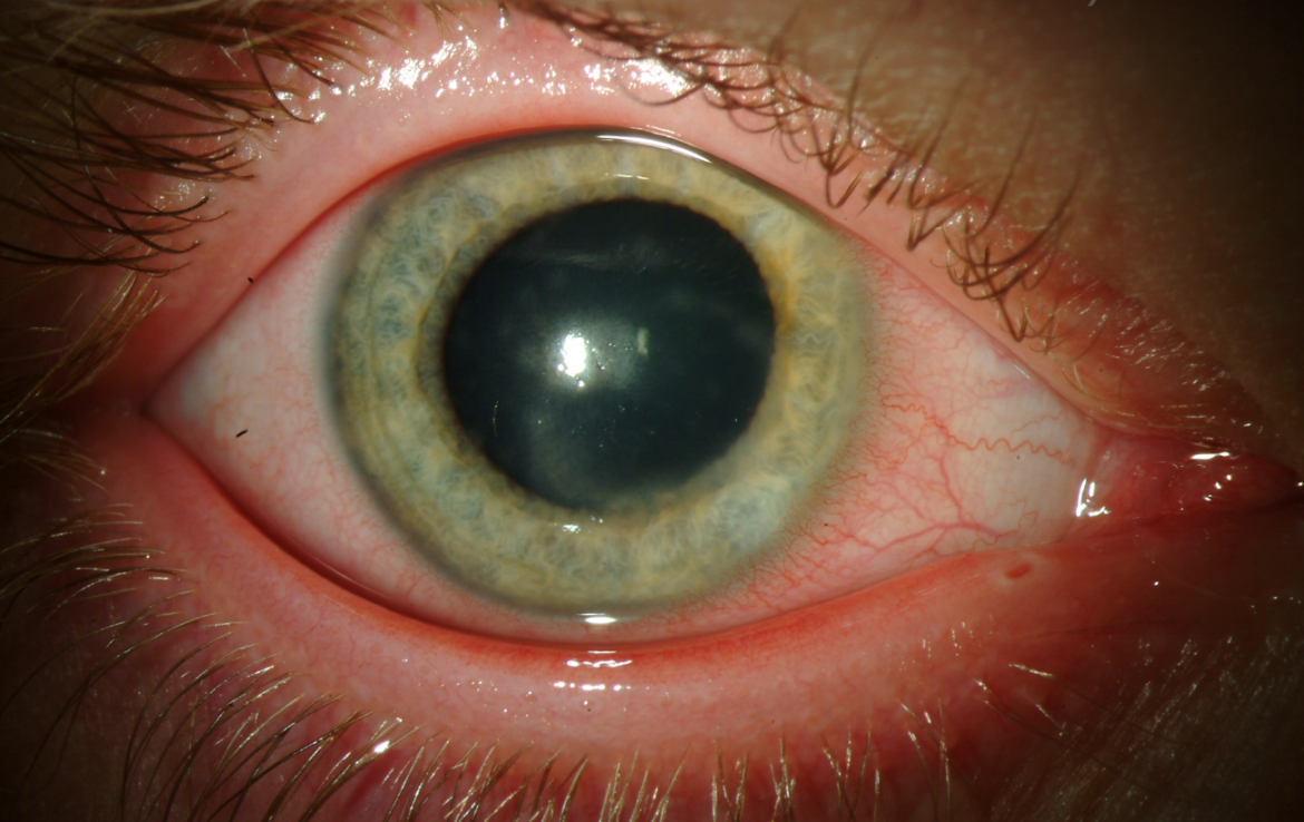 red-ring-around-iris-eyelids-eye-socket-in-babies-more-american