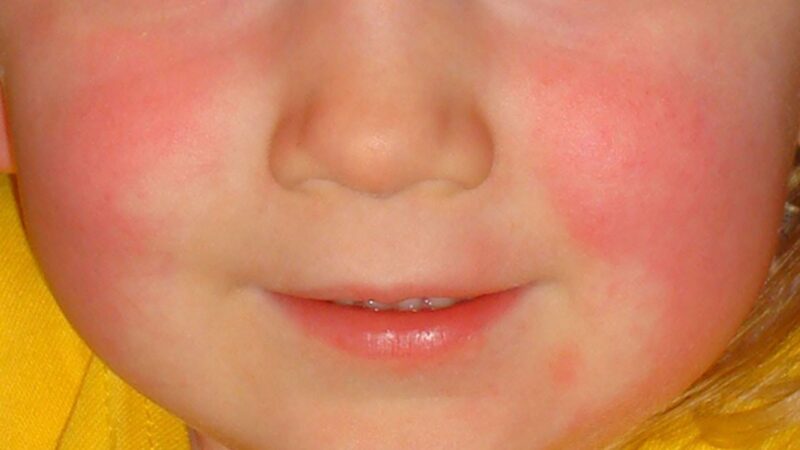 Itch or Non-Itchy Red Face Rash Causes and Treatments - American Celiac