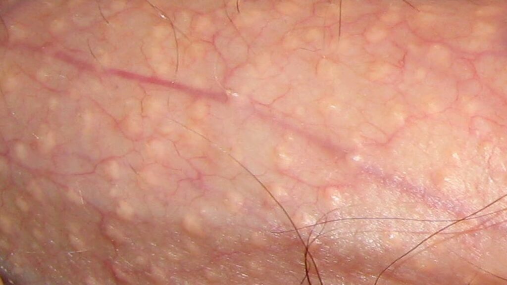 Causes of Fordyce spots on the shaft of a penis.