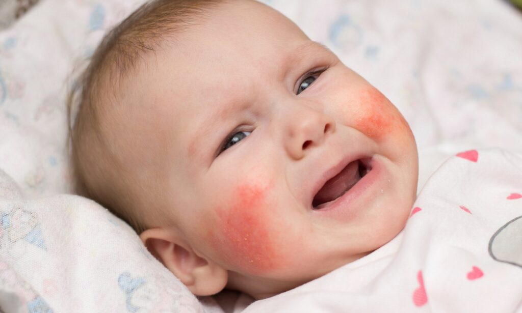 Itch or Non-Itchy Red Face Rash Causes and Treatments - American Celiac