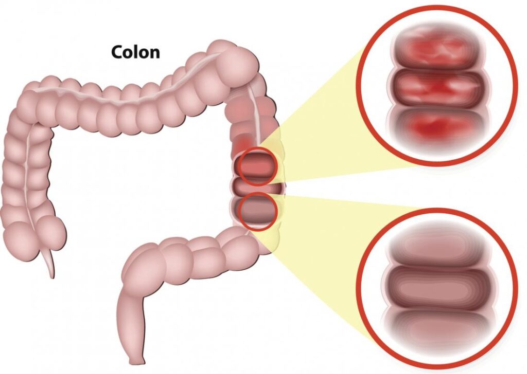 Left Right Swollen Colon Causes With Bloody Stools Cures American 