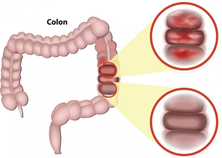 Left, Right Swollen Colon Causes, with Bloody Stools Cures - American ...