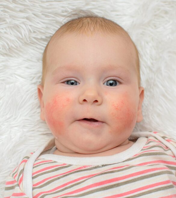 Swollen Cheeks Causes, Red, In Toddler and Inside Mouth American Celiac
