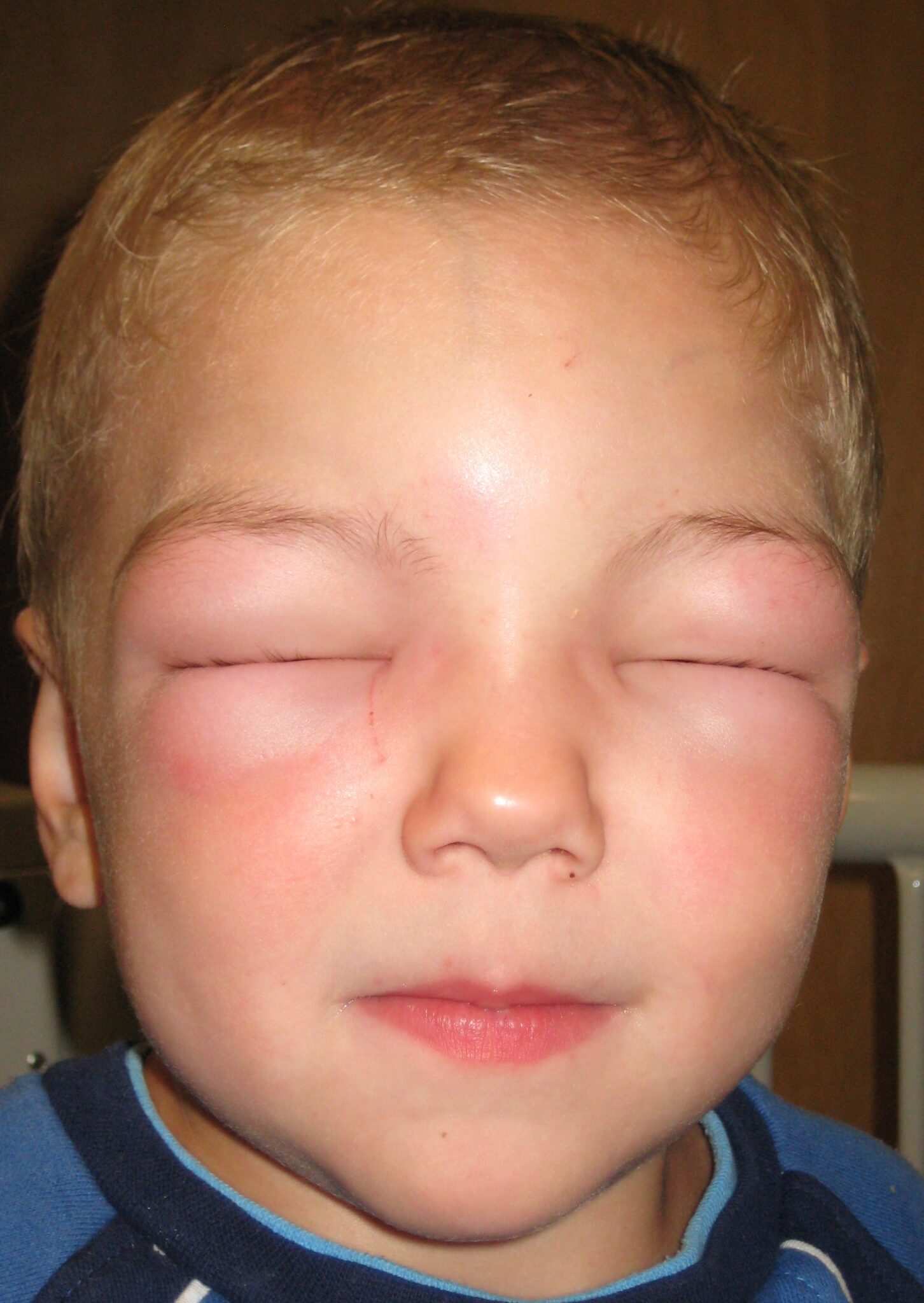 Swollen Cheeks Causes, Red, In Toddler and Inside Mouth American Celiac