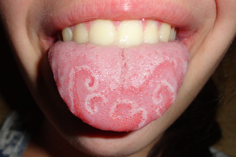 Geographic Tongue 768x512 1 