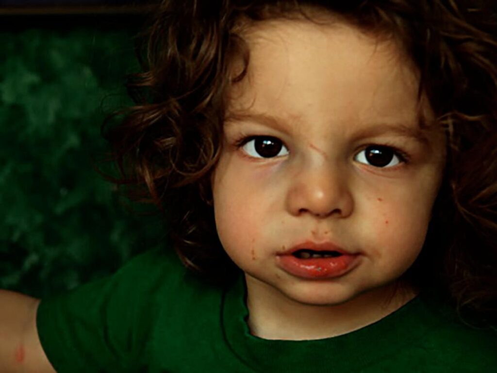 Swollen Cheeks Causes, Red, In Toddler and Inside Mouth American Celiac