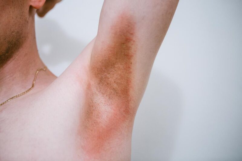 Underarm Rash Causes Pictures Painful Red And Itchy Rash Treatment