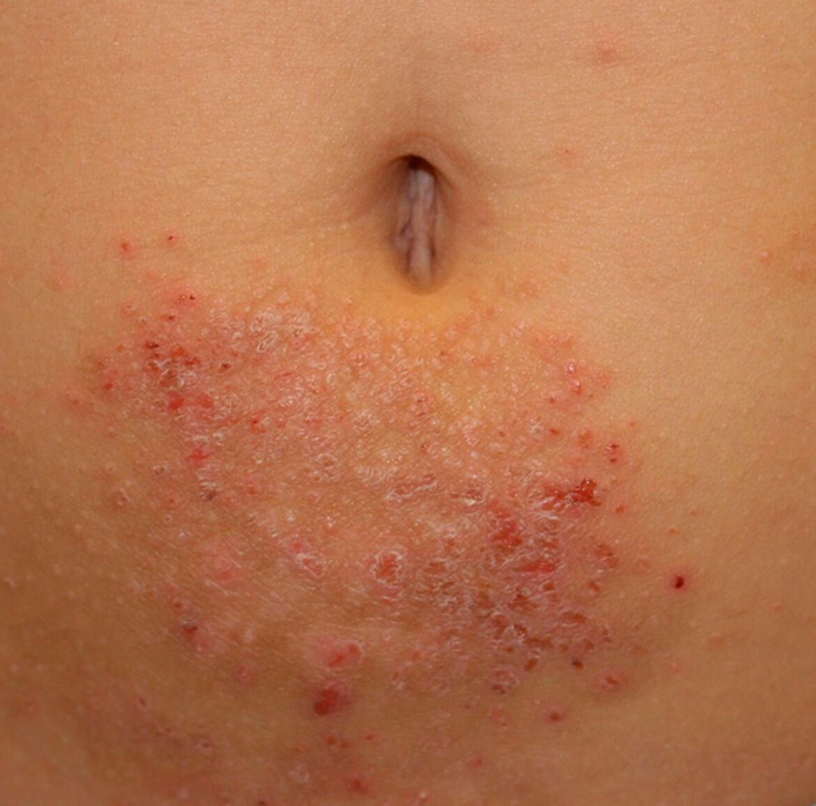 Rash on Stomach Causes, Pictures and Back, Breast, Groin, Belly Button