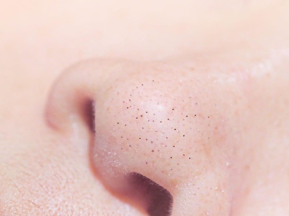 Get Rid Clogged Pores on Nose, Squeeze, Clean, Remedies, Causes of