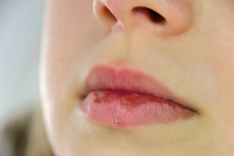 Bumps on Lips Small, Little, White or Red Causes & Treatment American
