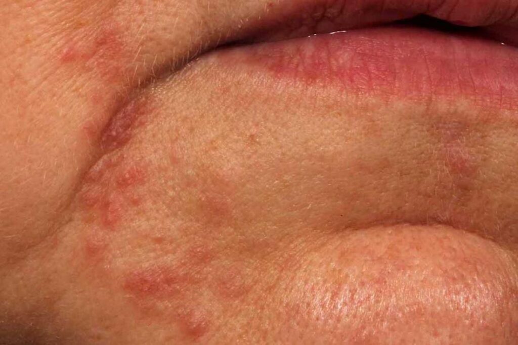 White Spots On Lips Causes Pictures Small On Lower Upper Inside