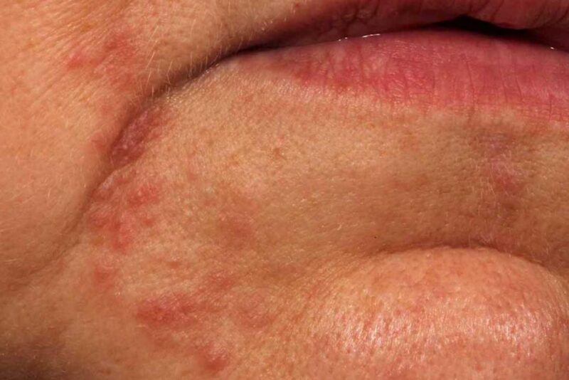 white-spots-on-lips-causes-pictures-small-on-lower-upper-inside