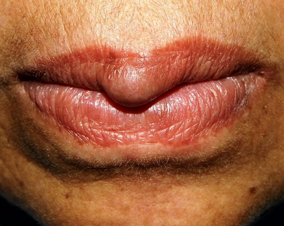 White Spots On Lips Causes Pictures Small On Lower Upper Inside