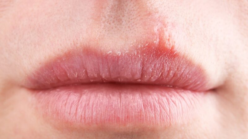 Hard Bump On Lips Including Lip Line 