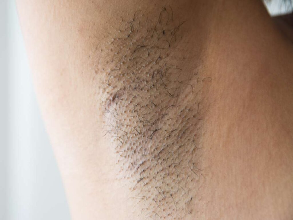 Underarm Rash Causes Pictures Painful Red And Itchy Rash Treatment