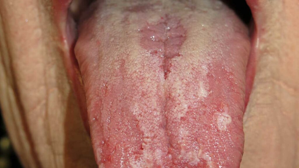 Red Spots On Tongue Under Back Tip Of Tongue American Celiac
