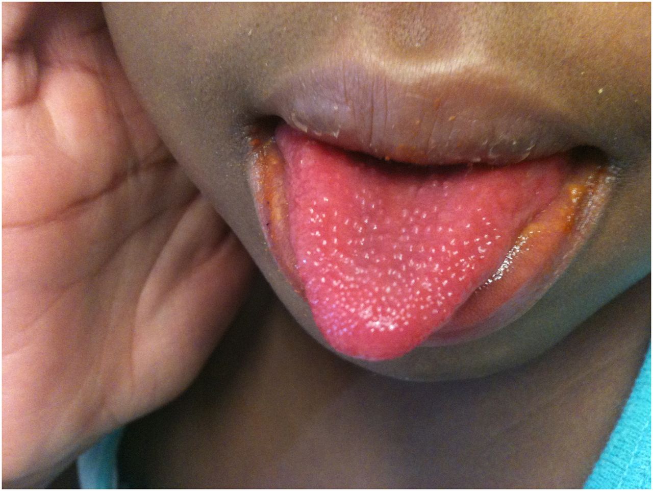 Red Spots on Tongue, Under, Back, Tip of Tongue - American Celiac