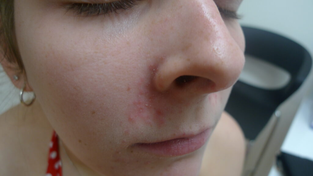 Nose Bumps Causes Including Small, Big, Painful, Hard Inside and on