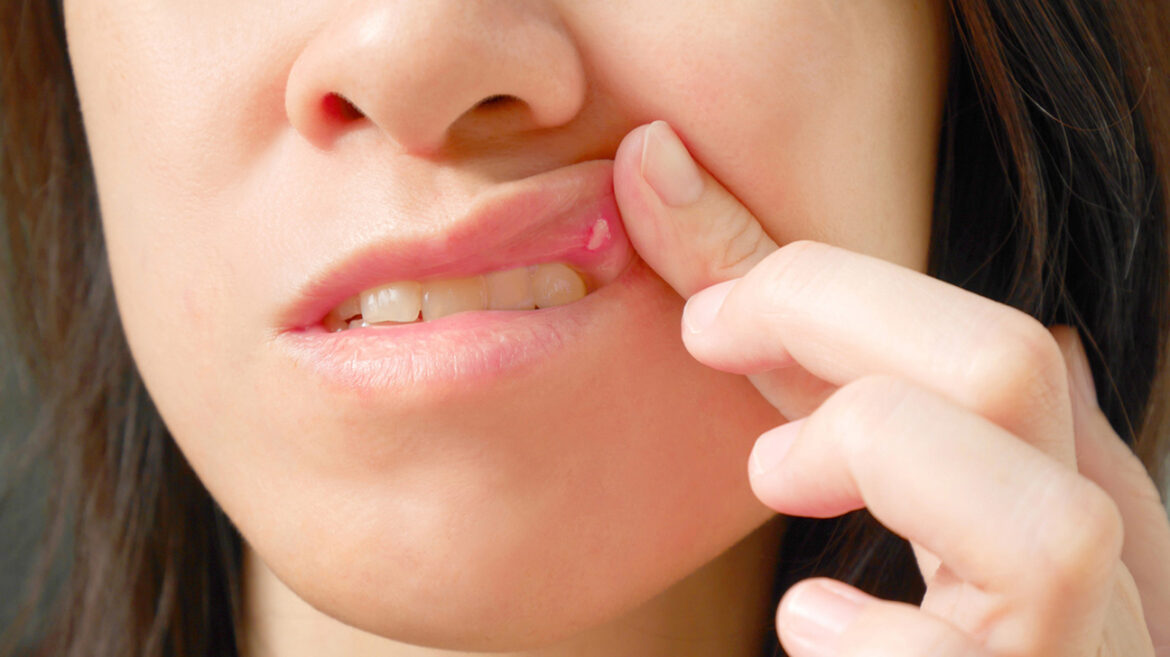 Get Rid of Lip Pimples Swollen, Big, Painful, Upper, Inside Around Your