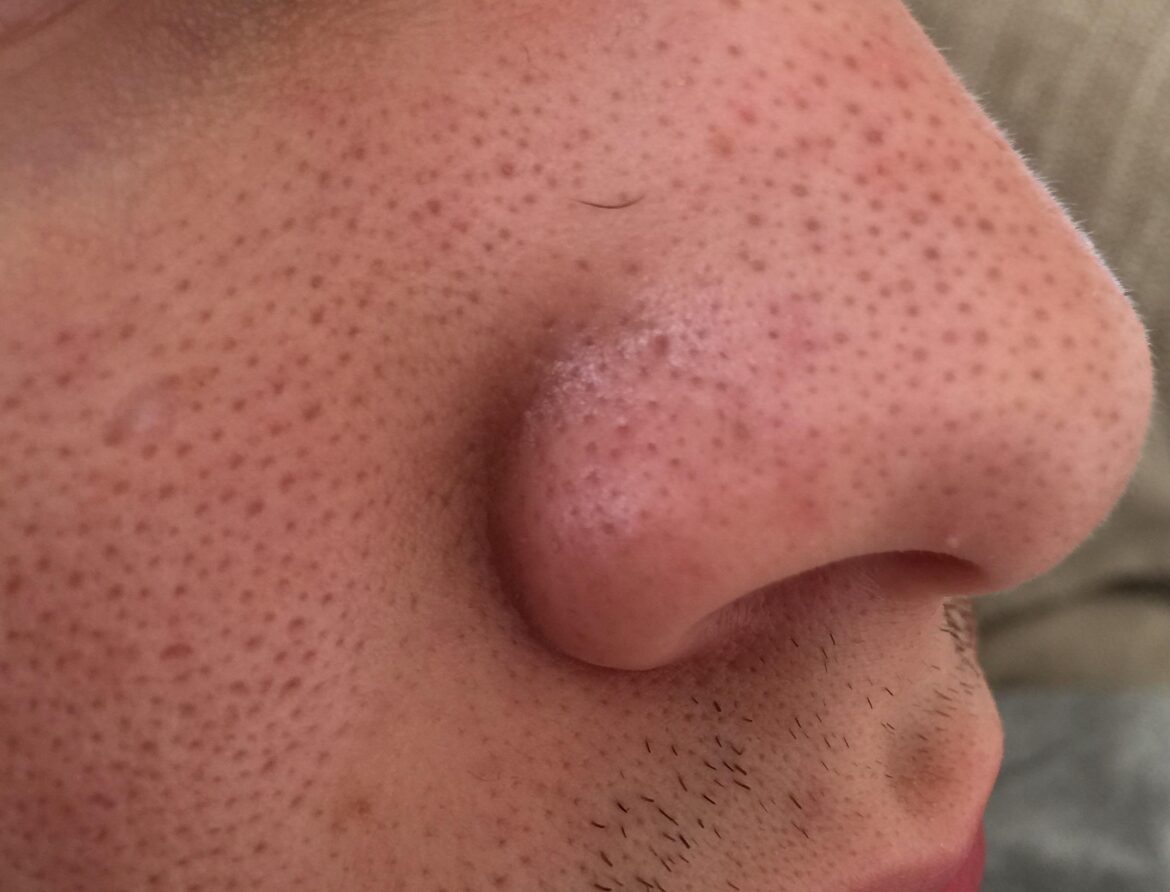 Get Rid Clogged Pores On Nose Squeeze Clean Remedies Causes Of 