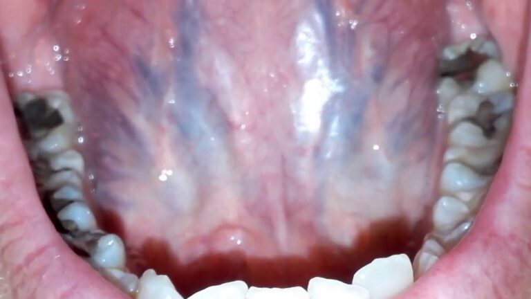 Purple Tongue Causes Including Spots Under Tongue Veins And Bumps American Celiac