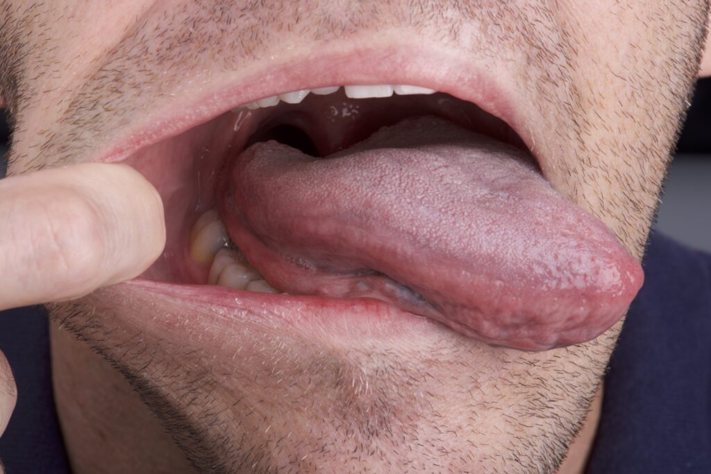 Halsentzündungen auf der Zunge - VyHow
