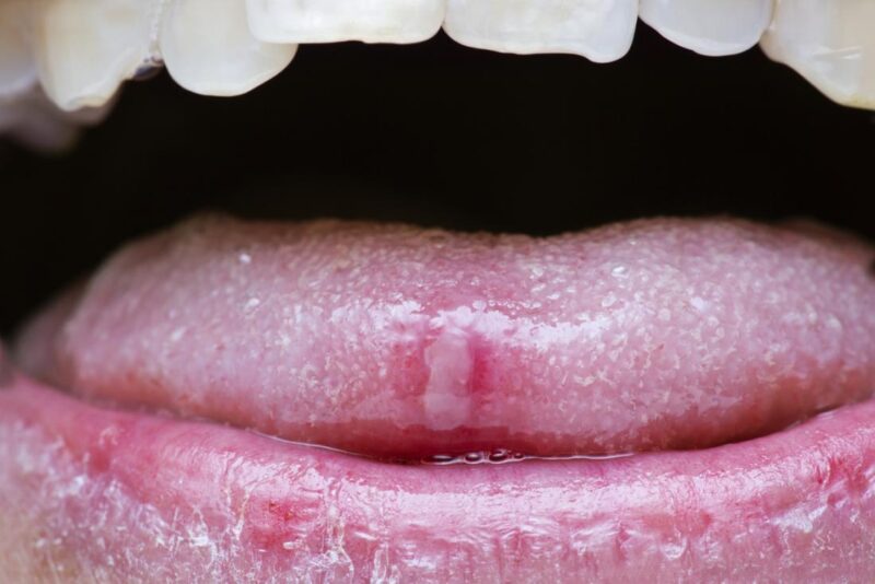 red-spots-on-tongue-under-back-tip-of-tongue-american-celiac