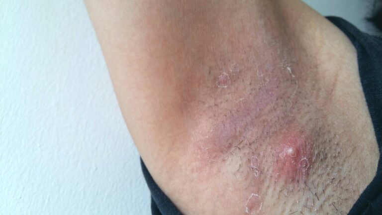 Violacious Underarm Rash Underarm Rash Causes, Pictures, Painful, Red & Itchy Rash Treatment ...