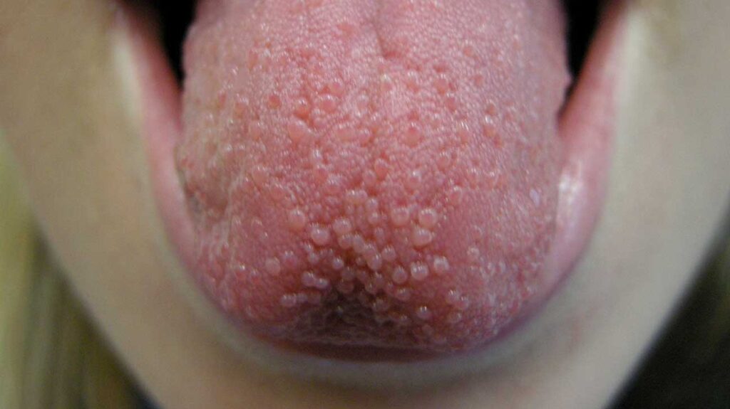 Pimples On Tongue Under Tip Side Or Back And Getting Rid Of.