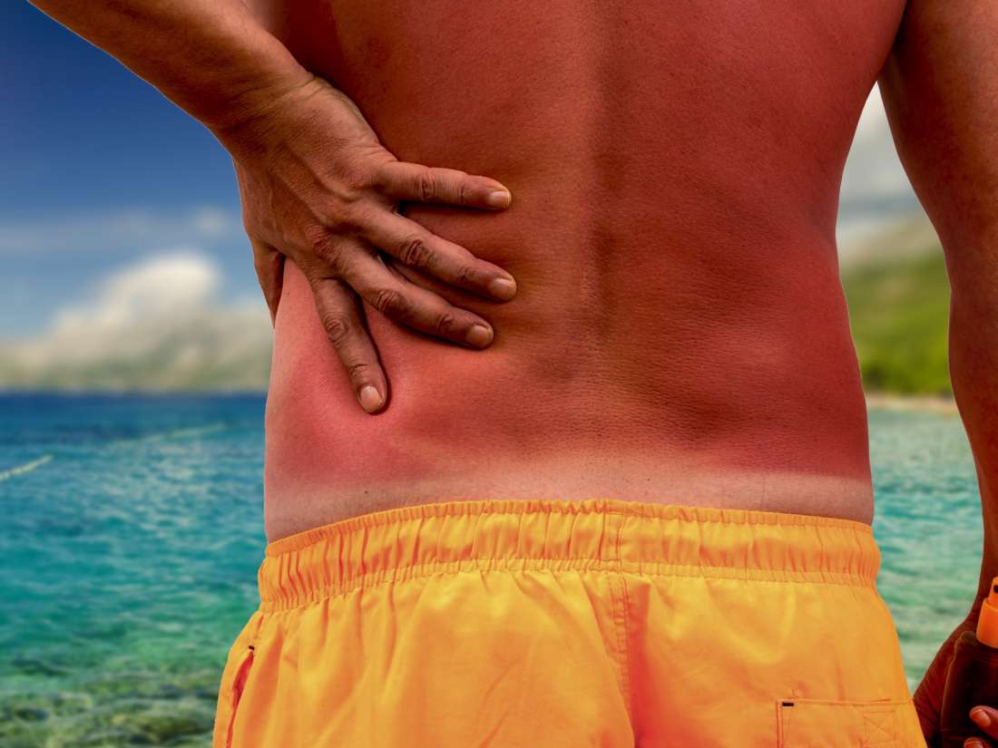 what will stop a sunburn from itching