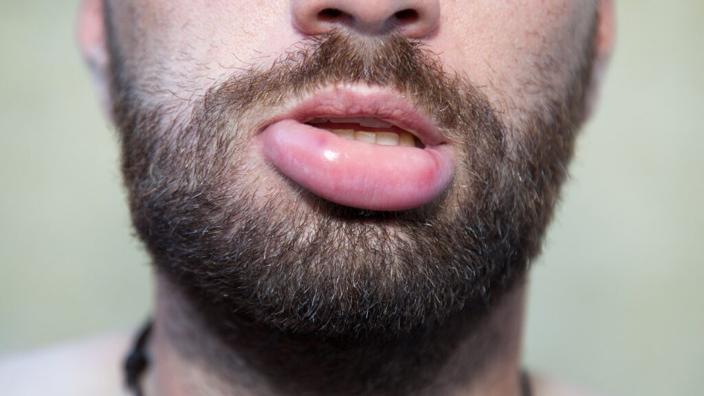 How to Get Rid a Swollen Lip, Heal, Treat and Reduce Lip Swelling