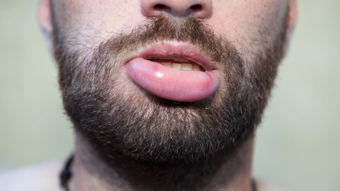 How to Get Rid a Swollen Lip, Heal, Treat and Reduce Lip Swelling American Celiac