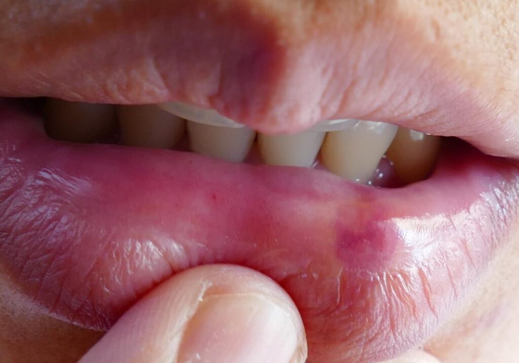 growing-white-lumps-pimples-inside-mouth-on-tongue-and-around-gums