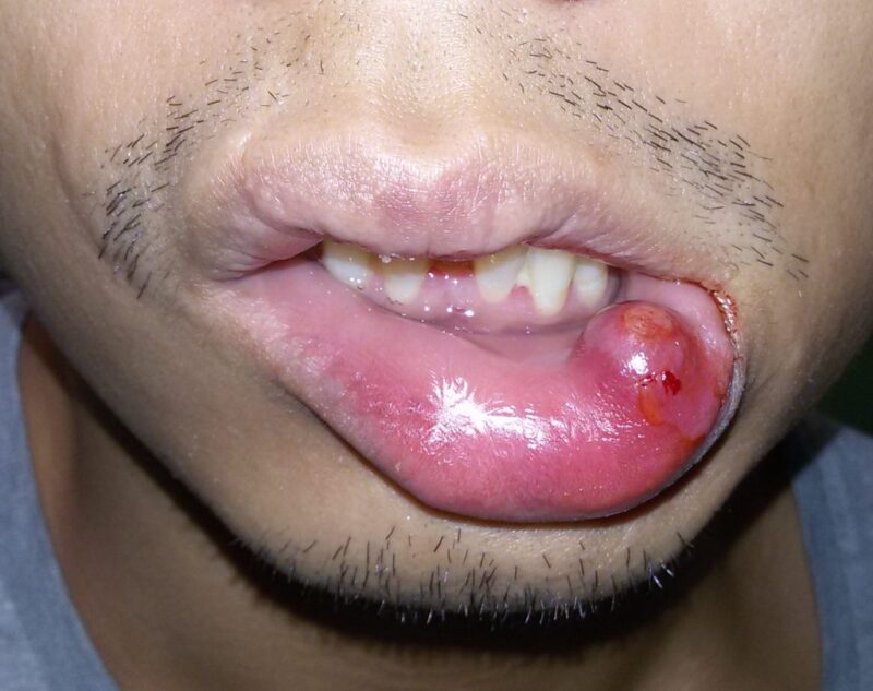 Swollen Bottom Lip, Causes, For No Reason, Treatment of Lower Lips