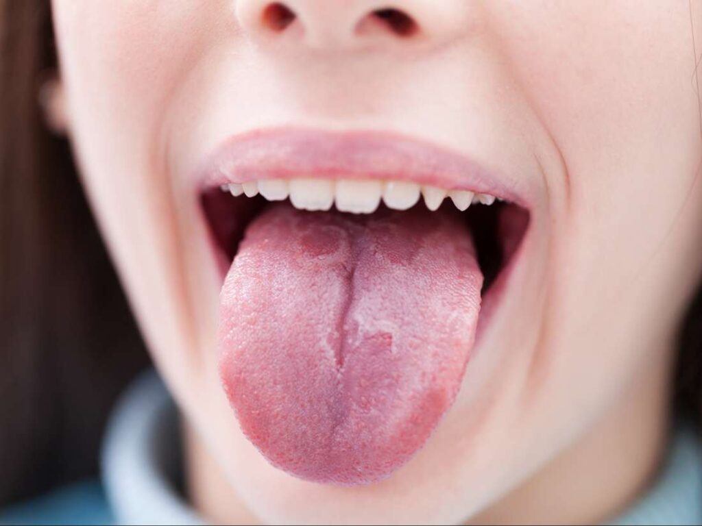 Tongue Swelling Causes Symptoms Treatment Piercing Under And One Side American Celiac